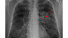 Progressive Fibrosing Interstitial Lung Disease: Shining a Light on the Latest Clinical Advances
