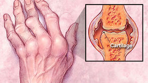 Ensuring Early Diagnosis and Targeting Treatment to Remission in Patients with Rheumatoid Arthritis