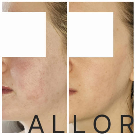 Microneedling Before And After1_edited.j