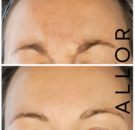 Botox® before and after results at ALLOR Cosmetic Medicine showing frown lines with brows drawn down in a frowning expression — smoother appearance after treatment