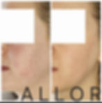 Side-by-side comparison of a face before and after microneedling skincare treatment. Left shows redness and blemishes; right shows smoother skin. Text: "ALLOR."