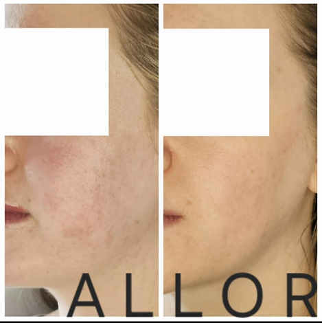 Left hand side face before and after photos showing smoother, rejuvenated skin following microneedling treatment at ALLOR Cosmetic Medicine, Auckland.