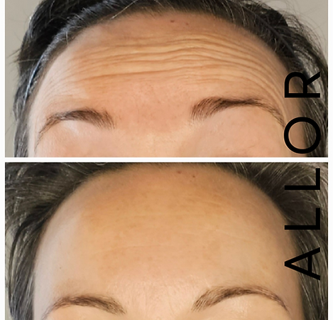 Botox® before and after results at ALLOR Cosmetic Medicine showing forehead lines with eyebrows raised — visible reduction in dynamic wrinkles post-treatment.