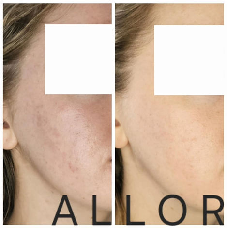 Right hand side face before and after photos showing smoother, rejuvenated skin following microneedling treatment at ALLOR Cosmetic Medicine, Auckland.