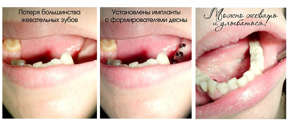 импланты нижней челюсти