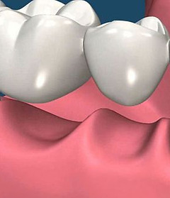 Tooth Bridge