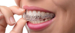 Invisalign Tray