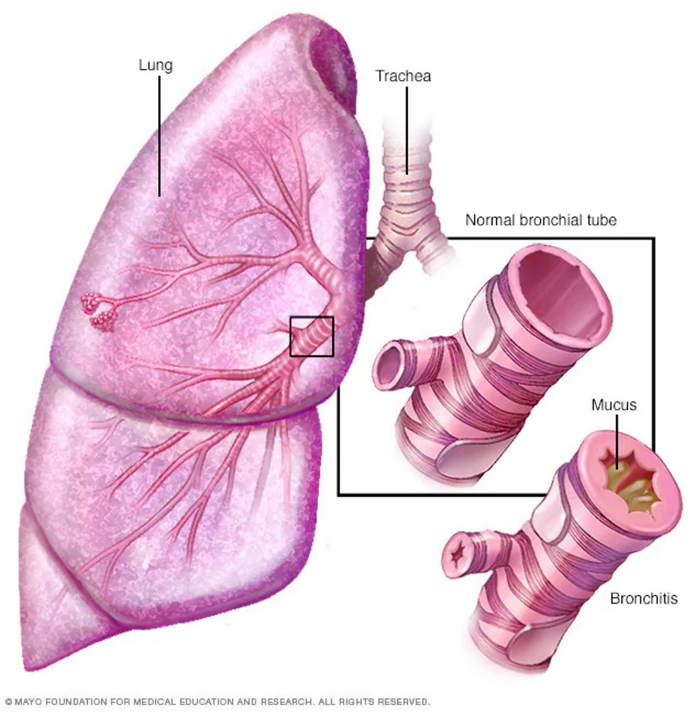 Thumbnail: MEE N6995-VIII Cures COPD in 3 months, 3か月でCOPDを治す。