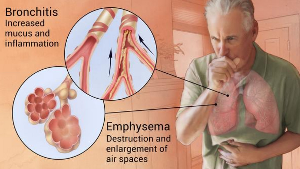 Thumbnail: MEE N6995-VIII Cures COPD in 3 months, 3か月でCOPDを治す。