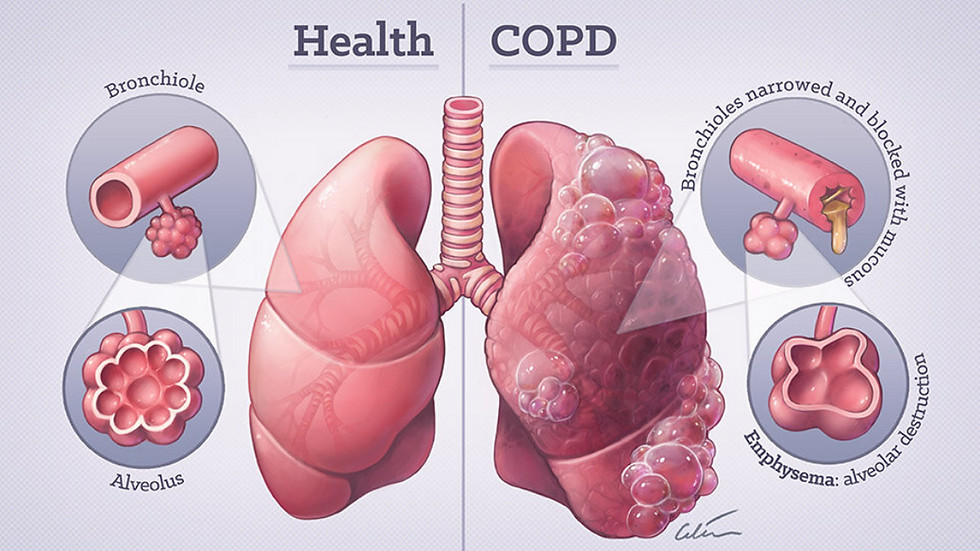 Thumbnail: MEE N6995-VIII Cures COPD in 3 months, 3か月でCOPDを治す。