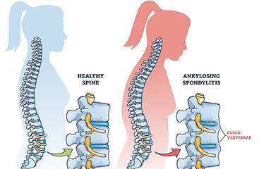 The image compare the healthy spine and ankylosing spondylitis 