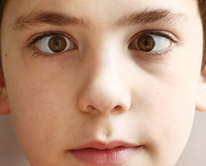 strabismus-Adobe-stock.jpeg