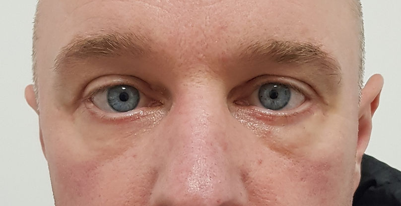 Lower Lid Blepharoplasty After (5 weeks post-op)