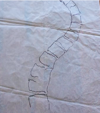 BEFORE – Tracing of Spinal XRay