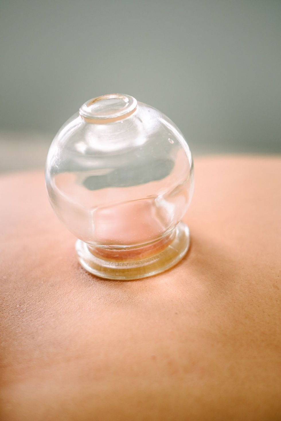 Acupuncture cupping.jpg