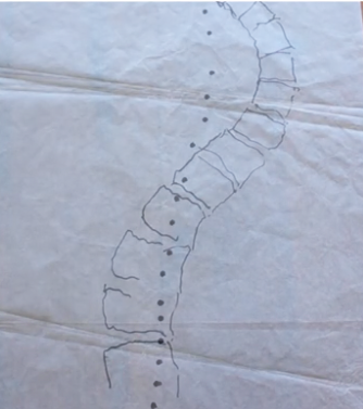 AFTER – Dots showing ‘after’ and improved spinal curvature are superimposed on tracing of spinal XRay