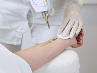 Laser para tatuagens e estrias: Tudo o que você precisa saber