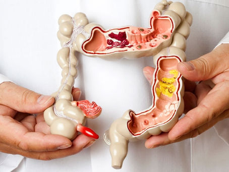 Irritable Bowel Syndrome (IBS) and Nutritional Guidance