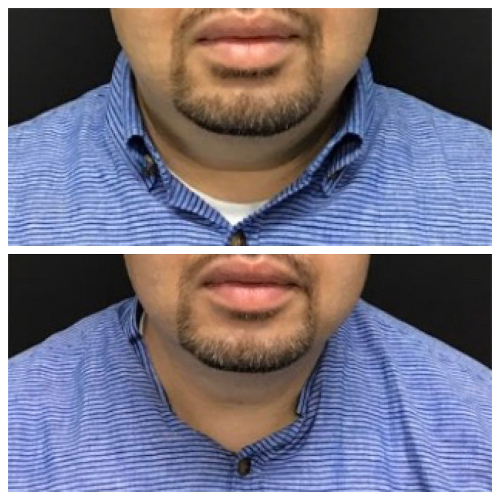 Submental fat after 1 treatment