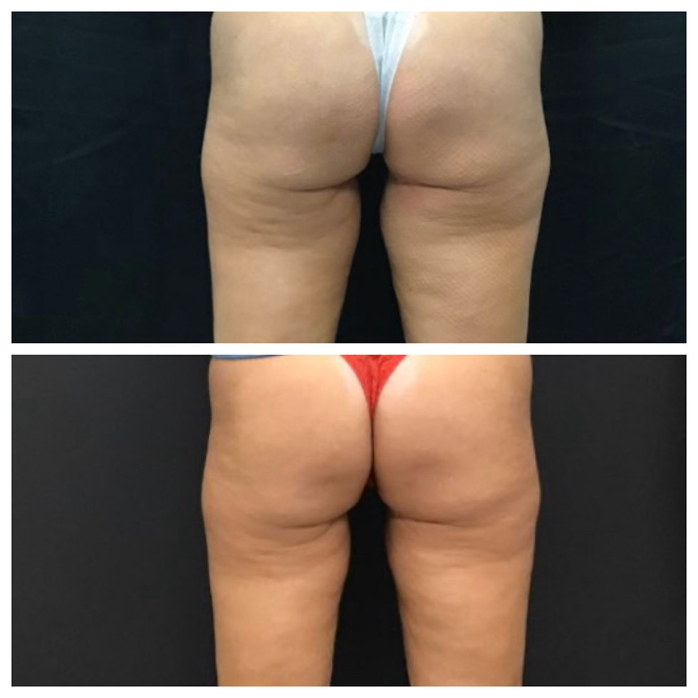 CoolSculpting inner thighs