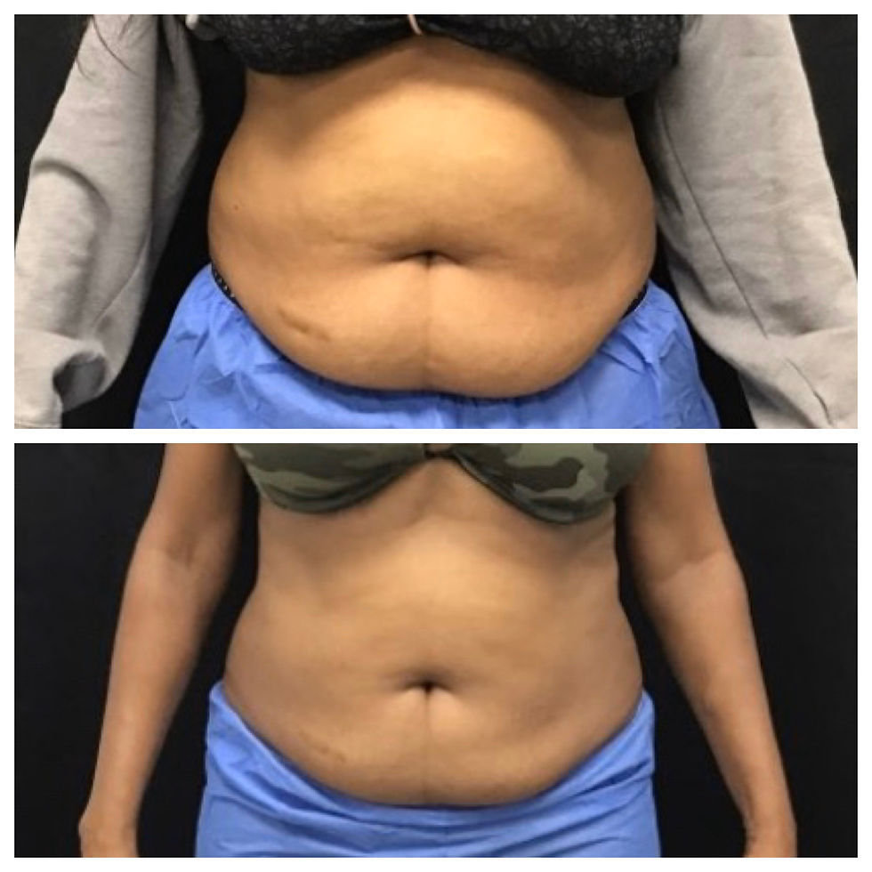 CoolSculpting abdomen after 2 treatments