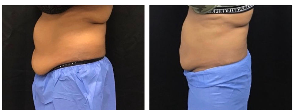 CoolSculpting abdomen after 2 treatments