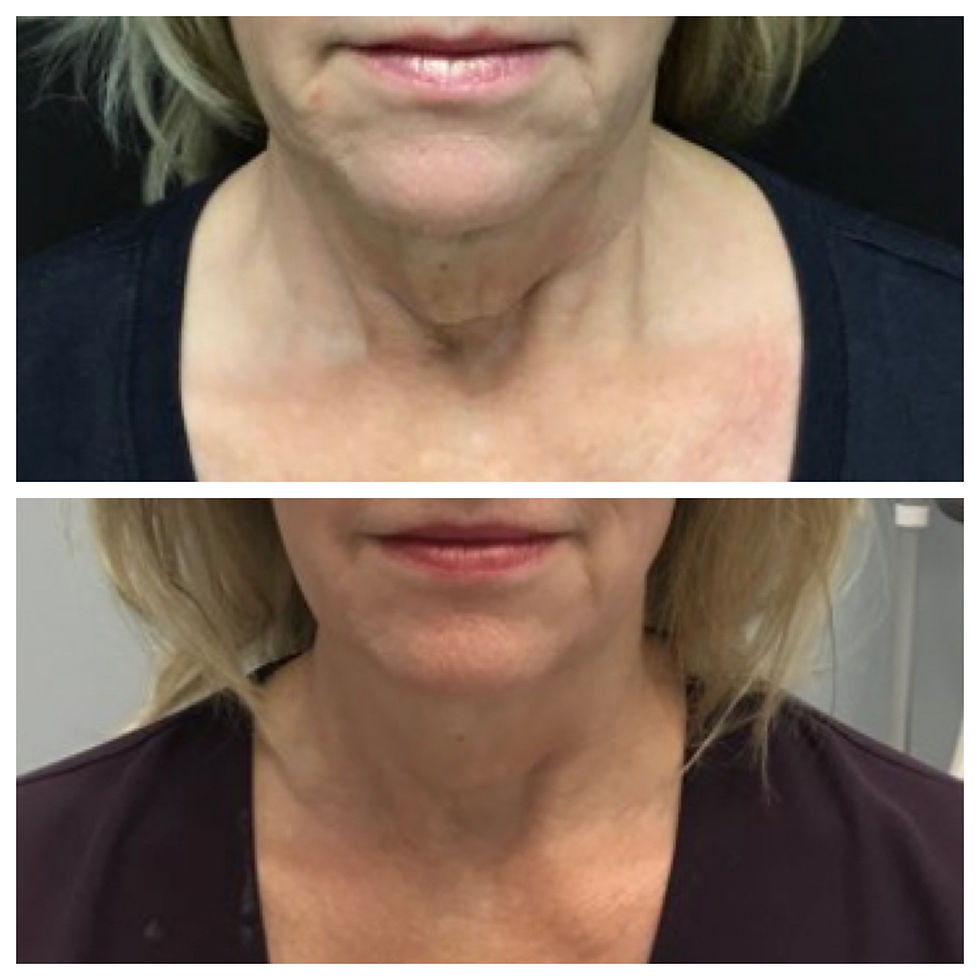 Titan sagging neck
