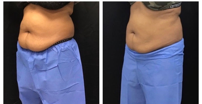 CoolSculpting abdomen after 2 treatments
