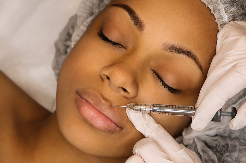 demonstration of Lip filler on a black woman laying down on the treatment table
