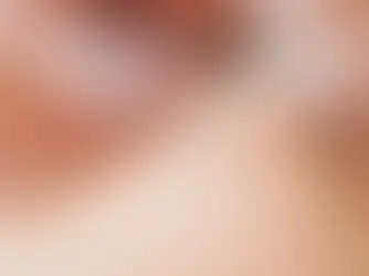 Électrolyse et pilosité hormonale : pourquoi c’est la solution la plus efficace