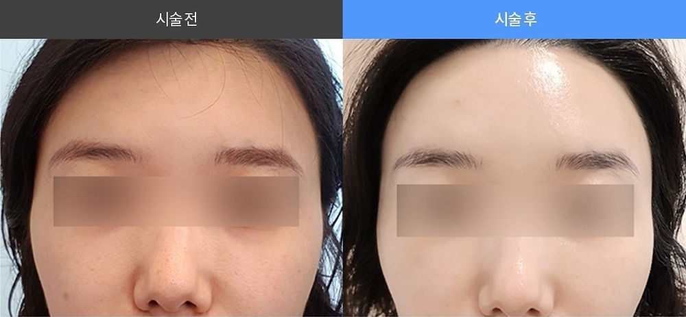รีวิวก่อน/หลัง ฉีดผิวด้วยรีจูรัน ฮีลเลอร์ (Rejuran Healer) ทั่วใบหน้า ผิวฉ่ำวาว Glass Skin