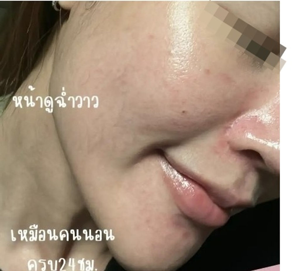 ฉีดผิวเมโสชาแนล (L'ebss) หน้าใสฉ่ำวาว