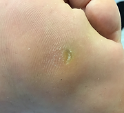 Corn on foot.png