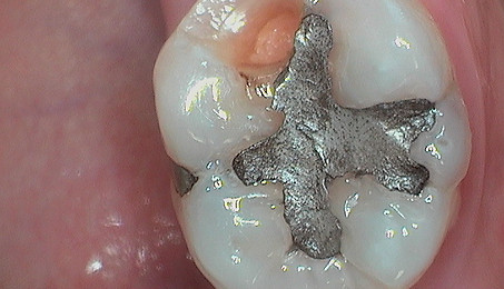 Amalgalm Filling.jpg