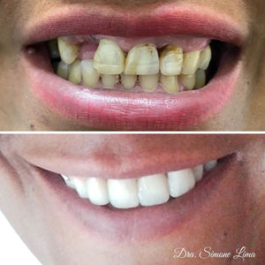 Prótese parcial removível, facetas e clareamento