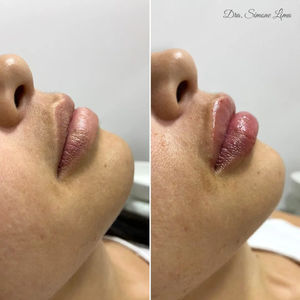 Preenchimento Labial