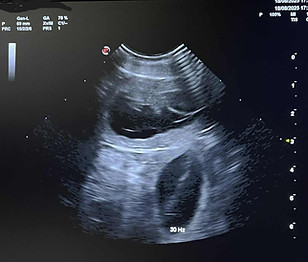echographie foetus