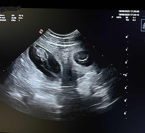 echographie d'un foetus