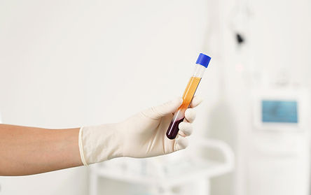 A hand in a medical glove holding a container with blood for PRP, PRF, EZ GEL treatment