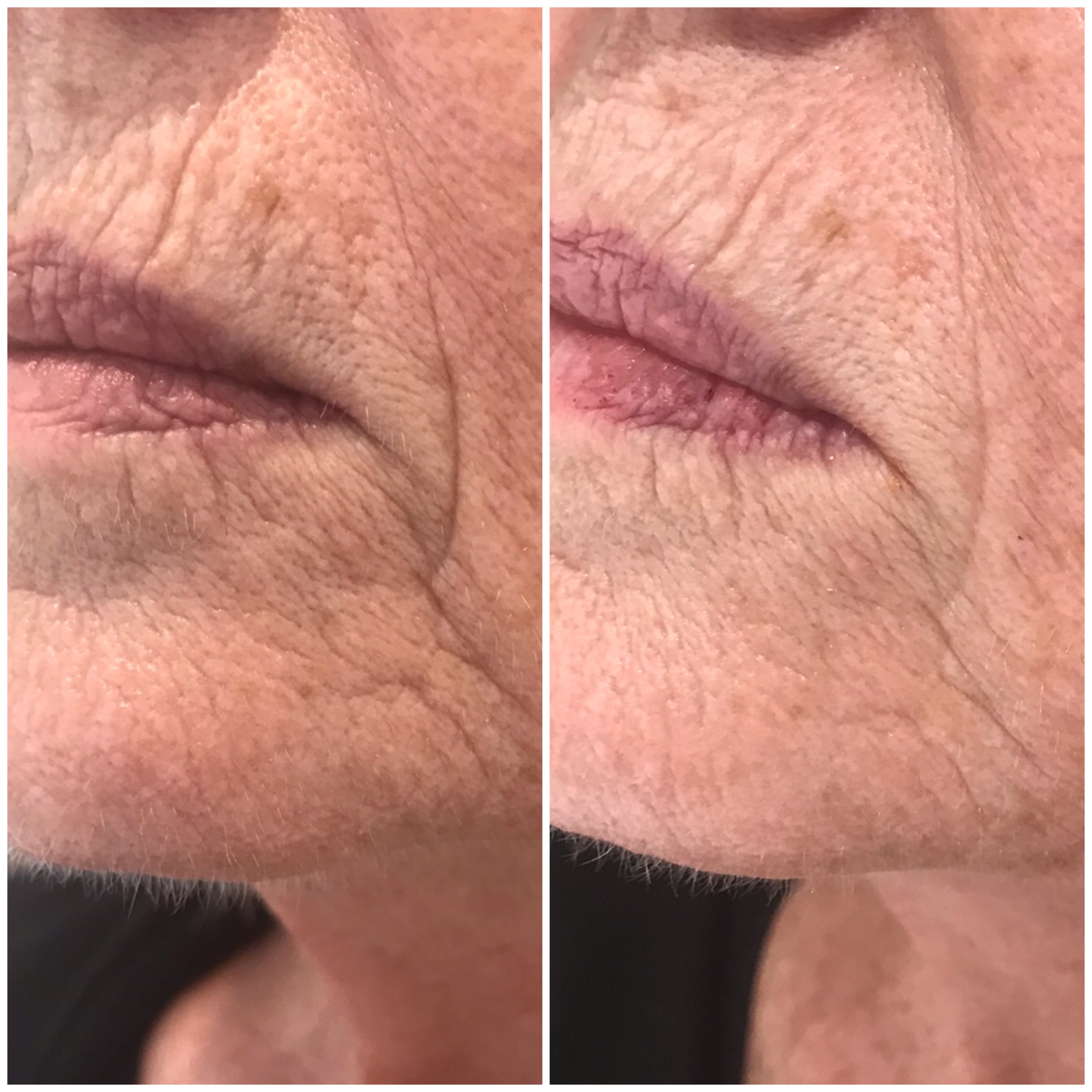 Dermapen