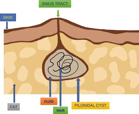 ingrown hair