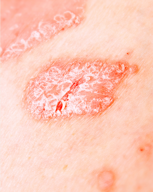 Psoriasis and Holistic Healing