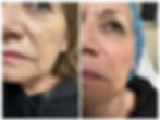 FILLERS