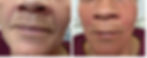 FILLERS
