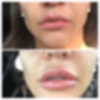 FILLERS