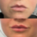 FILLERS