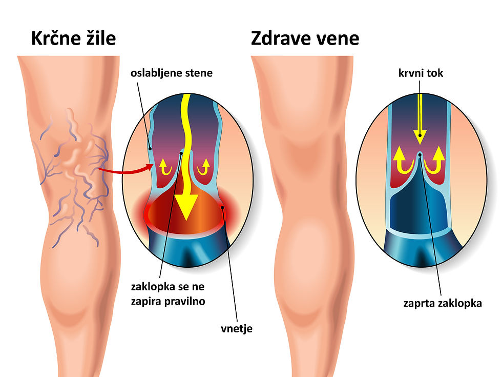 Odprta rana na nogi je lahko posledica venskega popuščanja