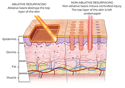 Non-ablative fractional laser treatment targeting skin texture, fine lines, acne scarring and pigmentation at Pure Aesthetics
