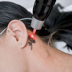 laser tattoo removal Mandurah