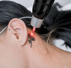 laser tattoo removal Mandurah